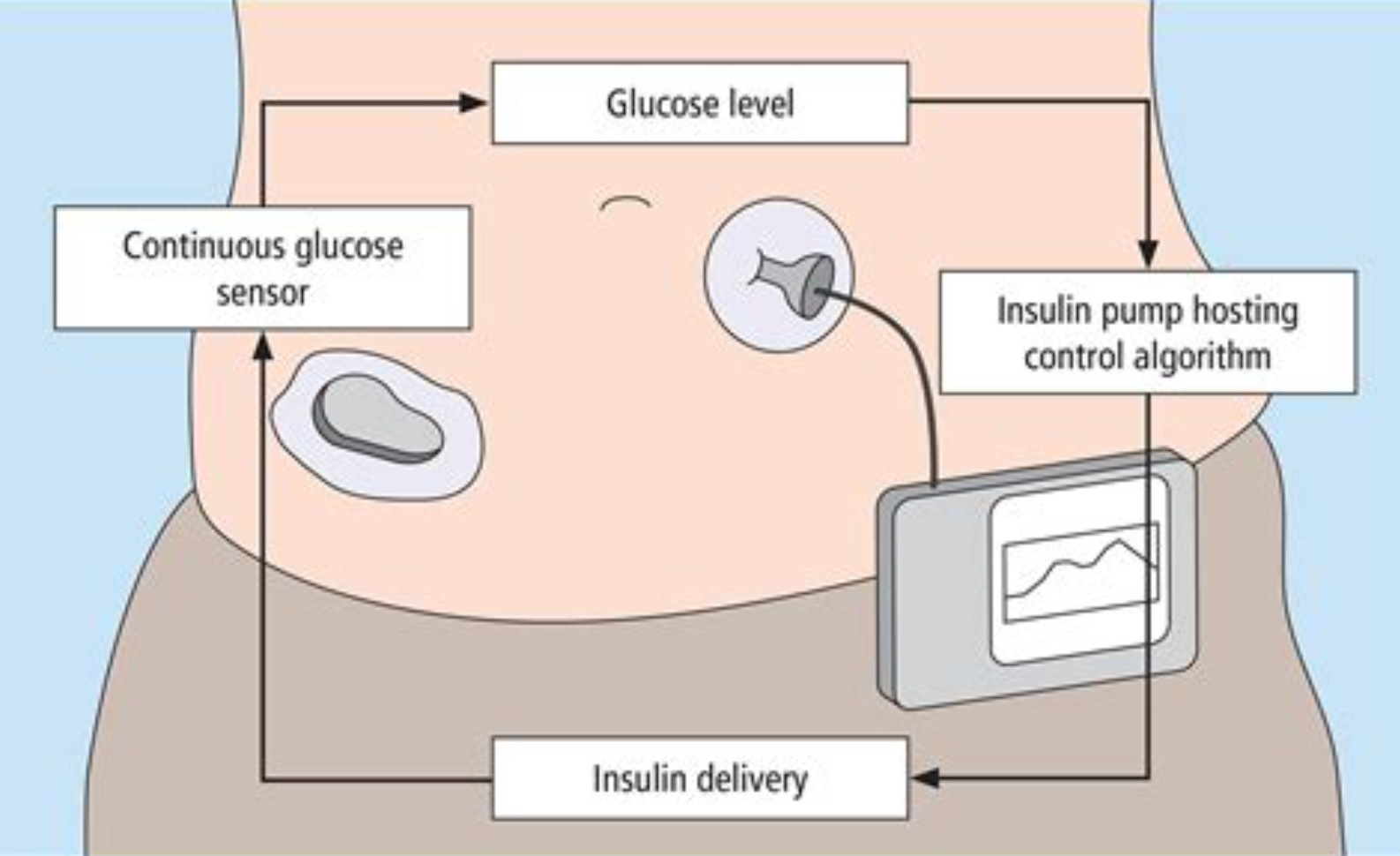 Introduction to Omnipod 20   Love My Libre