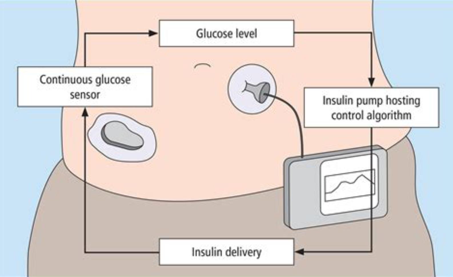 About Hybrid Closed Loop for T1D
